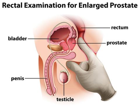 St George Urology Benign Prostatic Hyperplasia BPH