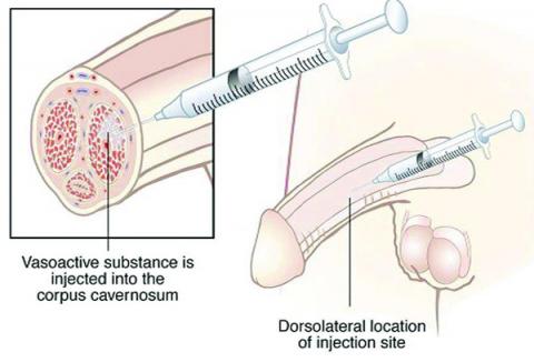 St George Urology Intracavernosal Injection Instructions