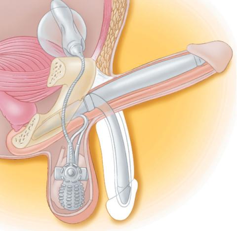 St George Urology Penile Prosthesis for Erectile Dysfunction