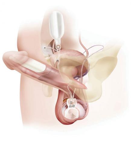 St George Urology Penile Prosthesis for Erectile Dysfunction