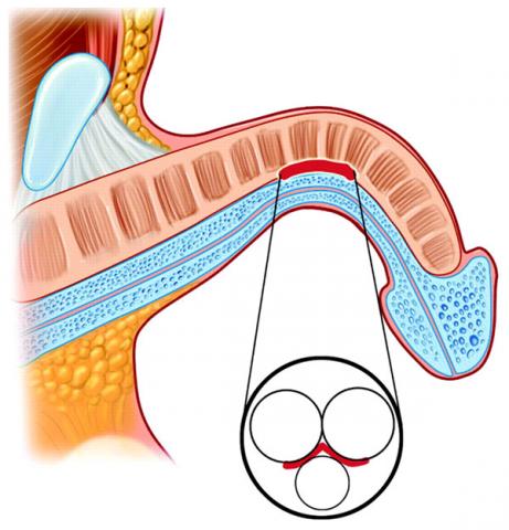 St George Urology Peyronie s disease