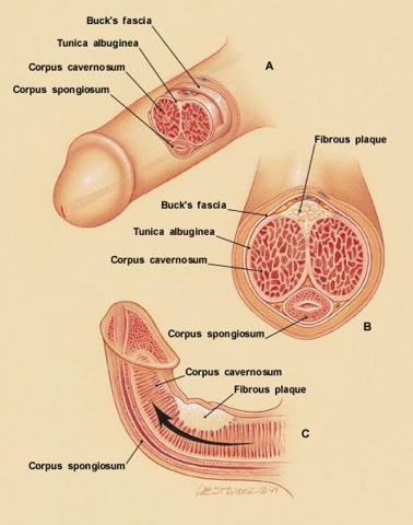 St George Urology Peyronie s disease