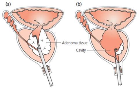 St George Urology Transurethral Resection of Prostate TURP