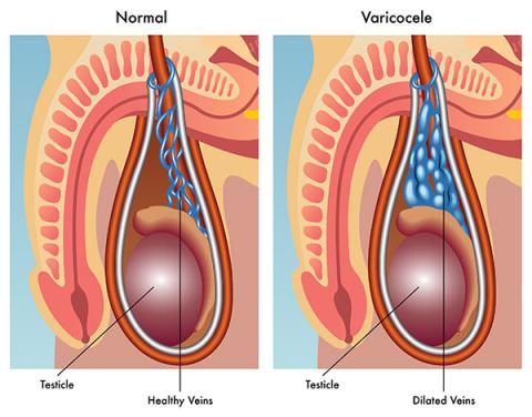 St George Urology Varicocele